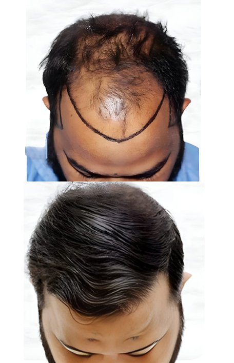 corrective-hair-transplant-service-inter