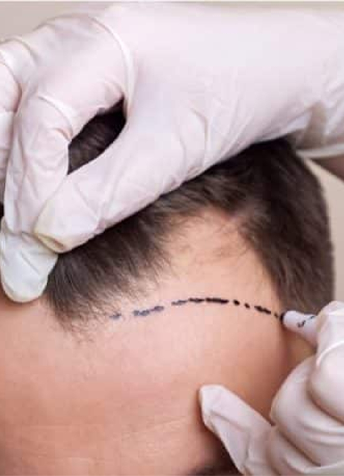 shami-hair-transplant-latest